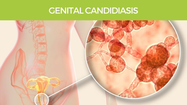 Genital vaginal candidiasis