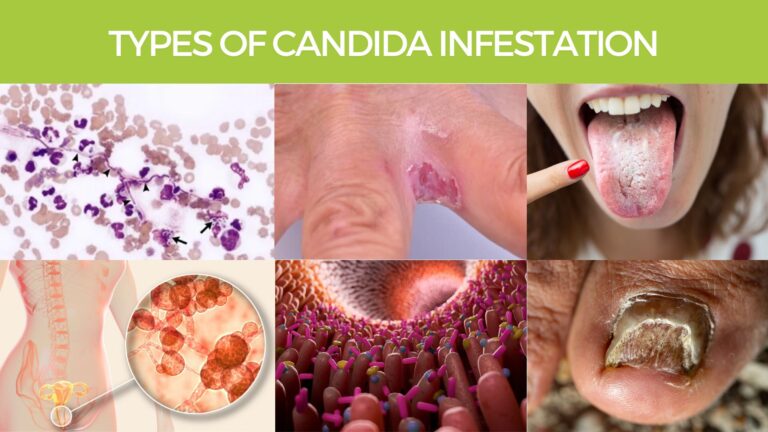 Types Of Candida Infestation in Humans