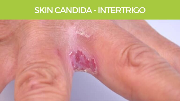 skin Candida - intertrigo