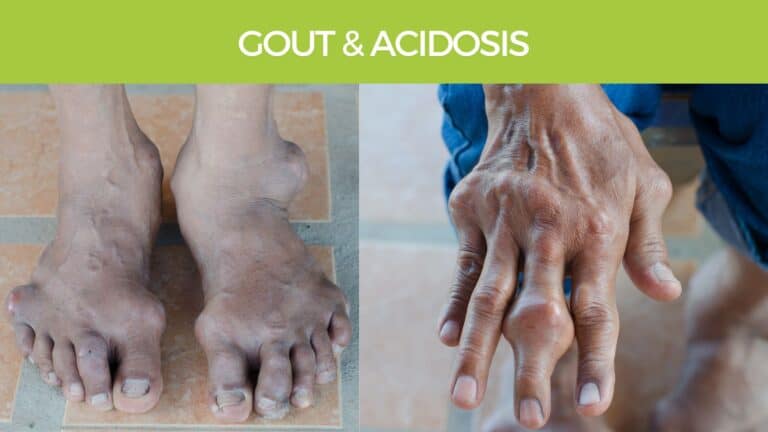 Uric Acid Gout and acidosis - alkaline diet detox