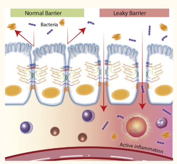 Leaky Gut Syndrome - Causes And Natural Solutions