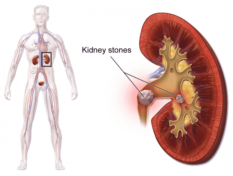 kidney_stones